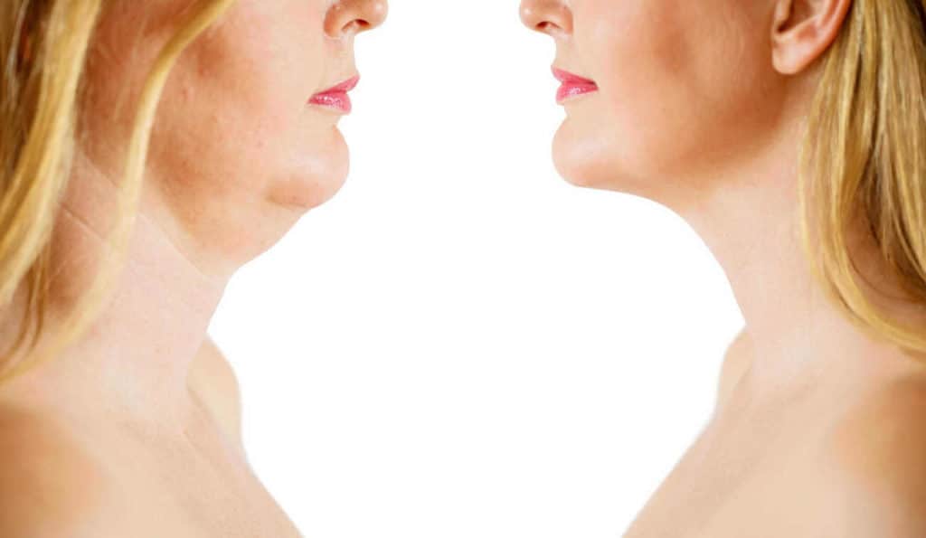 Double Chin treatment Swindon before and after results