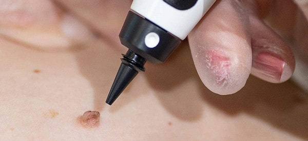 After Skin Tag Removal Swindon