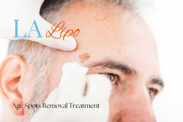 What Are the Most Effective Treatments for Age Spots Swindon?