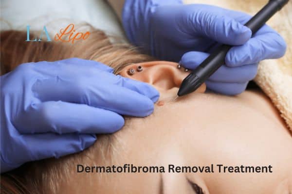 Dermatofibroma Removal Treatment Swindon