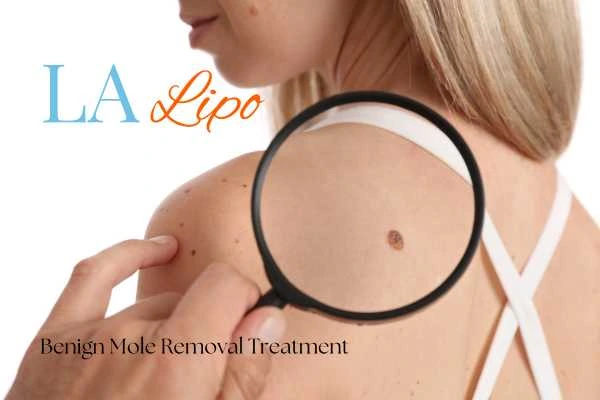 Woman having her inspection of blemish before mole removal Swindon