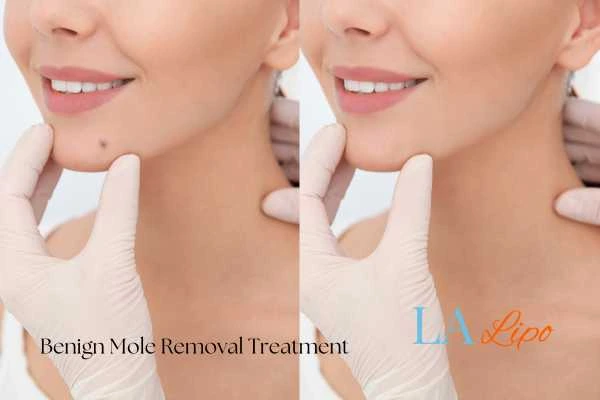 woman's before and after mole removal Swindon results