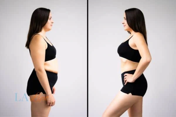 image of woman before and after results of LA-EMS Body Sculpting Swindon to help treat Diastasis recti