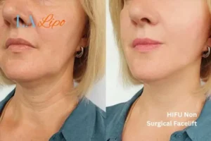hi-fu for wrinkles Swindon before and after results