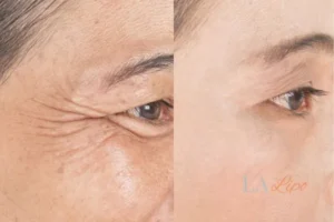 Before and after results of woman - HI-fu wrinkles reduction treatment Swindon