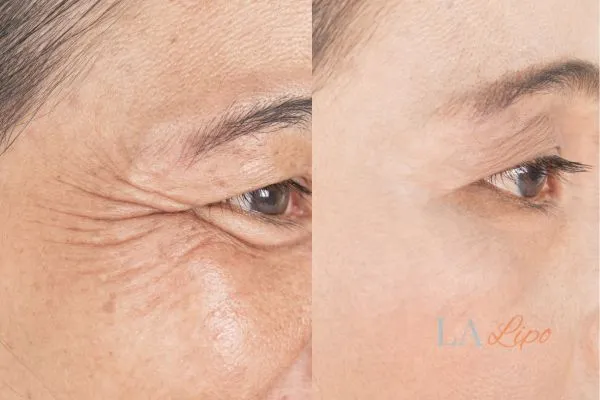 Before and after results of woman - HI-fu wrinkles reduction treatment Swindon