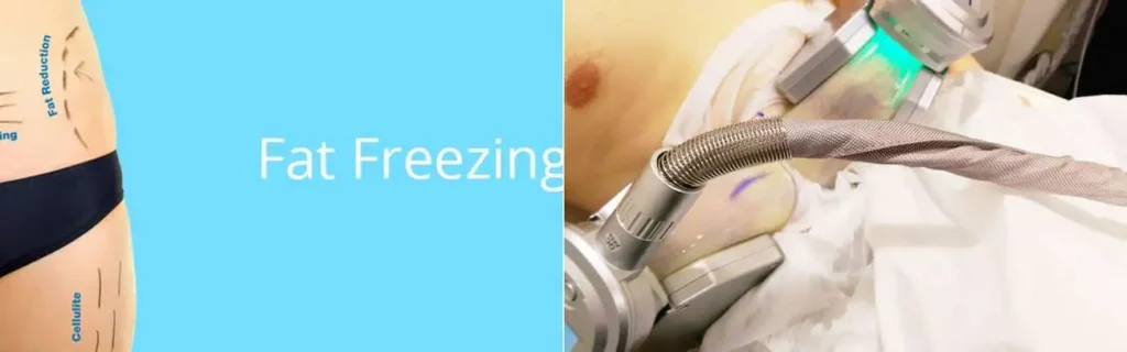 multi areas of a persons body having coolsculpting Swindon treatment