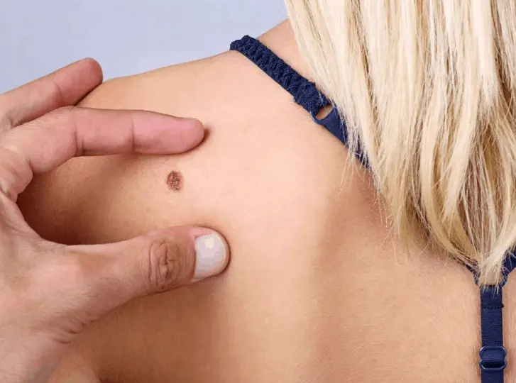 woman having mole removal Swindon consultation before treatment.