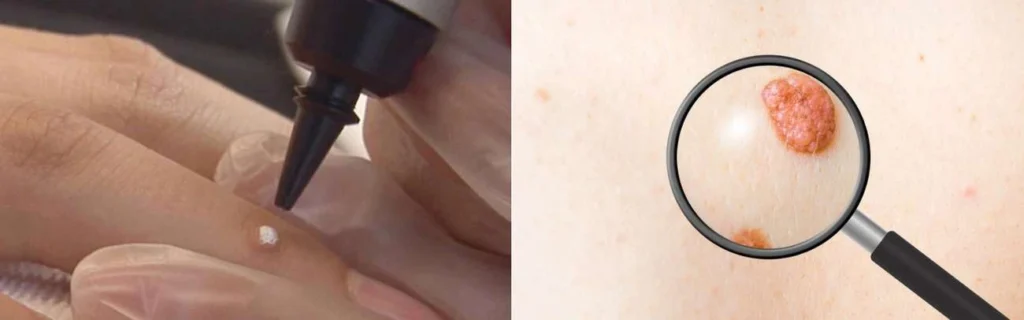 Person getting moles removed with cryopen Swindon