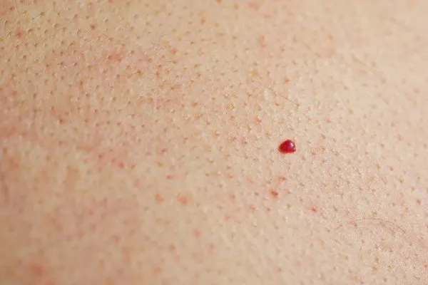 close up of a cherry angioma Swindon