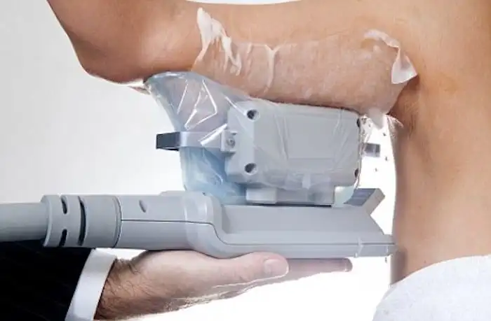 Picture of fat freezing Swindon on the upper arms.