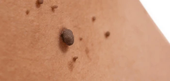 image of a skin tag Swindon