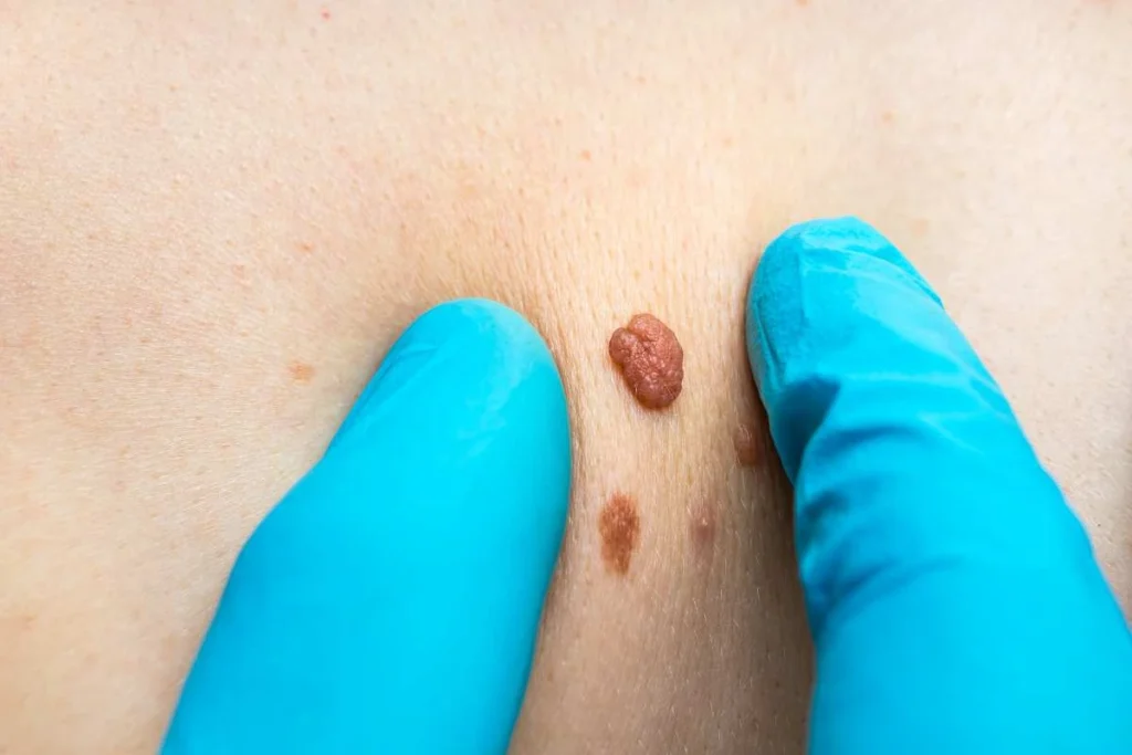 Consultant examining a skin tag Swindon