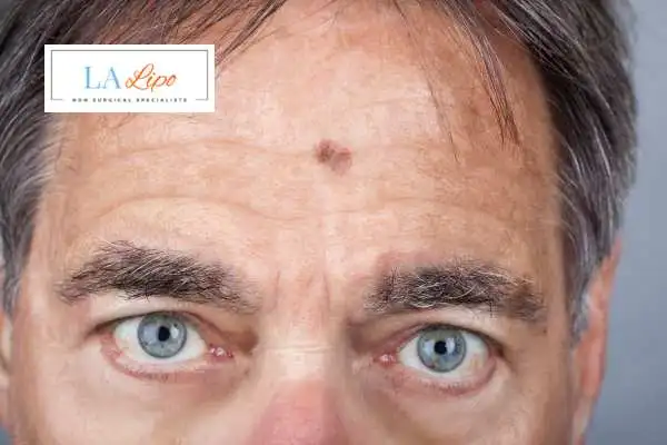 Solar Lentigo Removal Swindon image of man with mark on his forehead