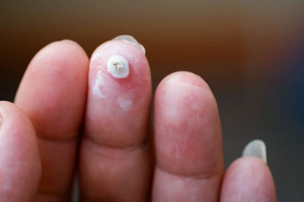 wart on person finger - cryotherapy to treat from LA LIPO Swindon