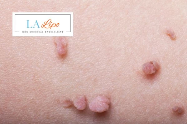Does cryopen skin tag removal Swindon hurt? Find out now call our team today!
