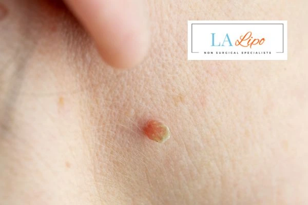 Book skin tag removal Swindon today speak to our team now!