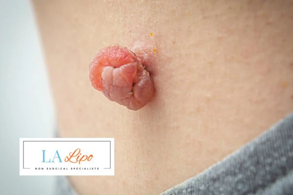 Interested in skin tag removal Swindon? Concerned about the pain? Find out more today!