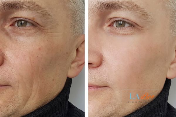 See the amazing results of Morpheus8 Treatment Swindon!