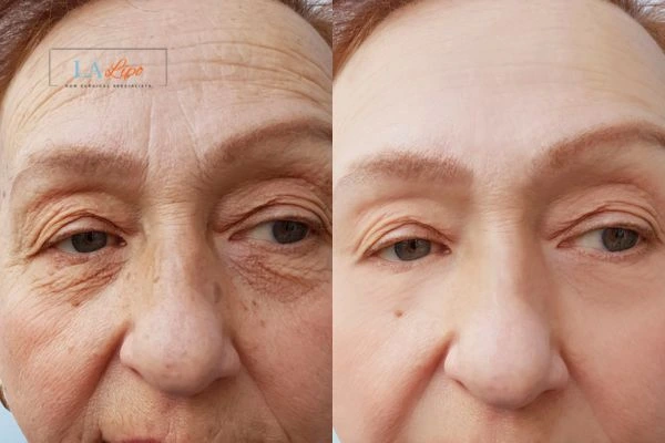 The powerful benefits of Morpheus8 Treatment Swindon - Call Our team today!