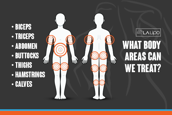 Diagram to show areas you can have LA-EMS Body Sculpting Treatment Swindon