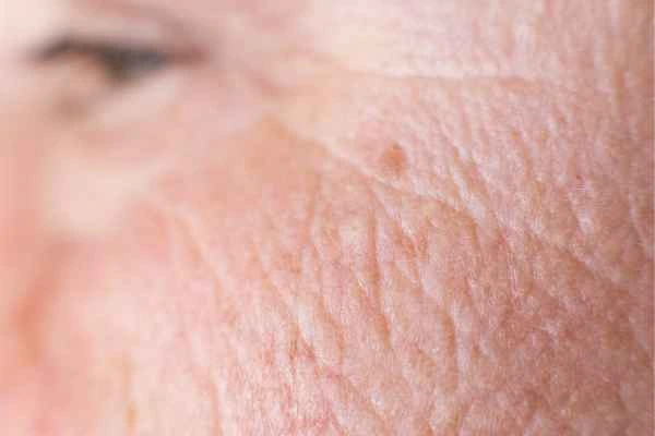 close up picture of a woman's face showing an age spot Swindon