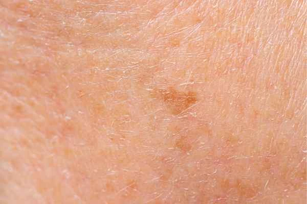 close up picture of age spots Swindon