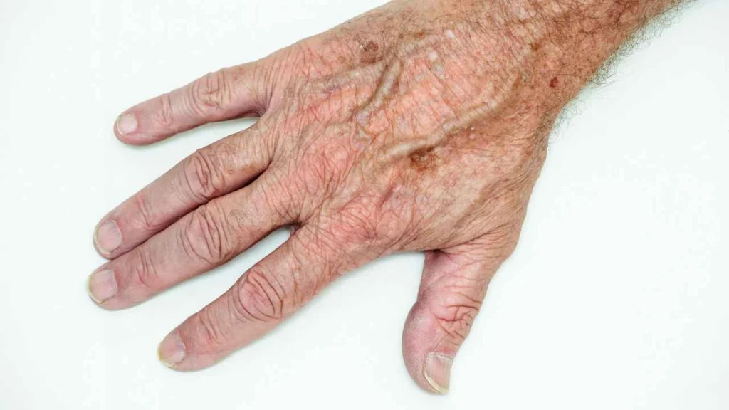 Male hand showing age spot Swindon