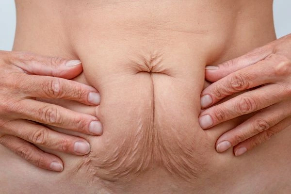 Image of a woman's stomach with loose skin - example of skin tightening Swindon options