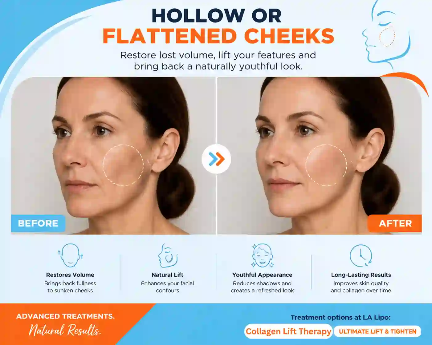 Sign #4: Hollow or Flattened Cheeks Swindon