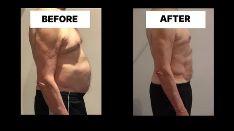 What Symptoms Can Diastasis Recti Cause in Men? Weak Core, Back Pain and Poor Posture Swindon